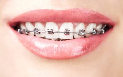 Why You Should Choose Damon Braces in Dubai: An Ode to Dr. Basel Mofti’s Expertise